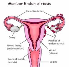 Cara Menyembuhkan Kista Endometriosis Secara Alami